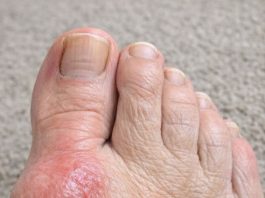 My mom is crying from the pain of this bump on her foot. She can’t even wear shoes and the specialist is booked for weeks. Does anyone have a quick fix?