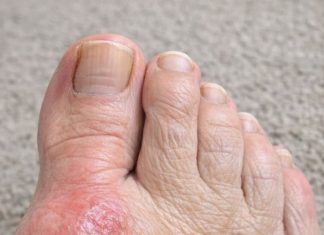 My mom is crying from the pain of this bump on her foot. She can’t even wear shoes and the specialist is booked for weeks. Does anyone have a quick fix?