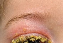 My toddler woke up with his eye completely glued shut by this yellow gunk. He keeps rubbing it and crying. We can’t see the doctor until Monday. How do I clean this safely?