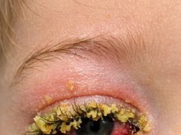 My toddler woke up with his eye completely glued shut by this yellow gunk. He keeps rubbing it and crying. We can’t see the doctor until Monday. How do I clean this safely?