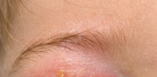 My toddler woke up with his eye completely glued shut by this yellow gunk. He keeps rubbing it and crying. We can’t see the doctor until Monday. How do I clean this safely?