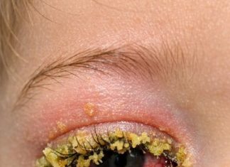 My toddler woke up with his eye completely glued shut by this yellow gunk. He keeps rubbing it and crying. We can’t see the doctor until Monday. How do I clean this safely?