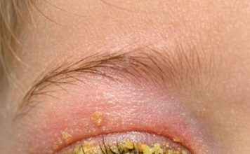 My toddler woke up with his eye completely glued shut by this yellow gunk. He keeps rubbing it and crying. We can’t see the doctor until Monday. How do I clean this safely?