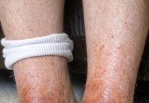 My dad’s ankles have turned this rusty brown color recently and the skin looks so thin and shiny. He says it’s incredibly itchy. His regular doctor is booked for weeks. Any ideas?