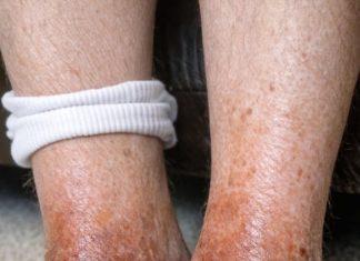 My dad’s ankles have turned this rusty brown color recently and the skin looks so thin and shiny. He says it’s incredibly itchy. His regular doctor is booked for weeks. Any ideas?