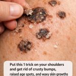 Put this 1 trick on your shoulders and get rid of crusty bumps, raised age spots, and waxy skin growths