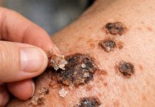 Put this 1 trick on your shoulders and get rid of crusty bumps, raised age spots, and waxy skin growths