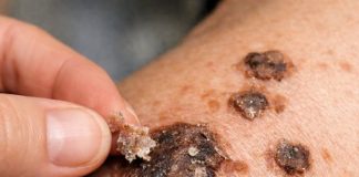 Put this 1 trick on your shoulders and get rid of crusty bumps, raised age spots, and waxy skin growths