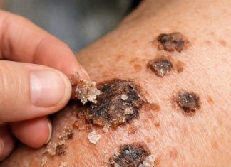 Put this 1 trick on your shoulders and get rid of crusty bumps, raised age spots, and waxy skin growths