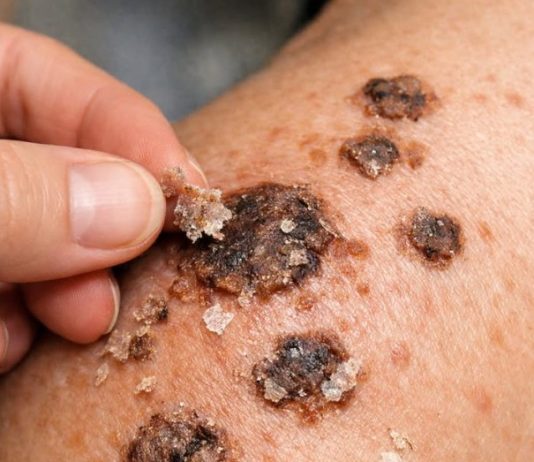 Put this 1 trick on your shoulders and get rid of crusty bumps, raised age spots, and waxy skin growths