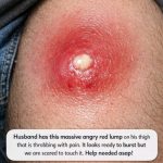 Husband has this massive angry red lump on his thigh that is throbbing with pain. It looks ready to burst but we are scared to touch it. Help needed asap!