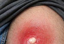 Husband has this massive angry red lump on his thigh that is throbbing with pain. It looks ready to burst but we are scared to touch it. Help needed asap!