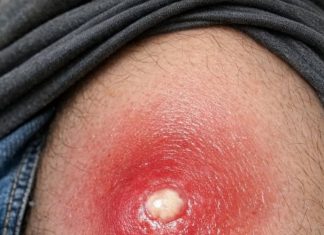 Husband has this massive angry red lump on his thigh that is throbbing with pain. It looks ready to burst but we are scared to touch it. Help needed asap!