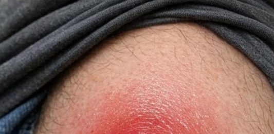 Husband has this massive angry red lump on his thigh that is throbbing with pain. It looks ready to burst but we are scared to touch it. Help needed asap!