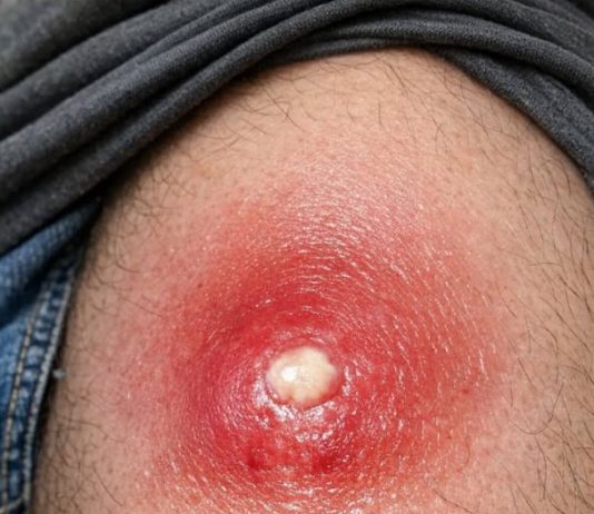 Husband has this massive angry red lump on his thigh that is throbbing with pain. It looks ready to burst but we are scared to touch it. Help needed asap!