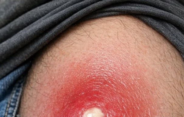 Husband has this massive angry red lump on his thigh that is throbbing with pain. It looks ready to burst but we are scared to touch it. Help needed asap!