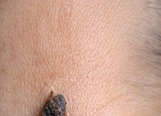 Rub this 1 trick on your neck and get rid of skin tags, dark spots, and raised bumps