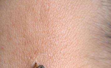 Rub this 1 trick on your neck and get rid of skin tags, dark spots, and raised bumps