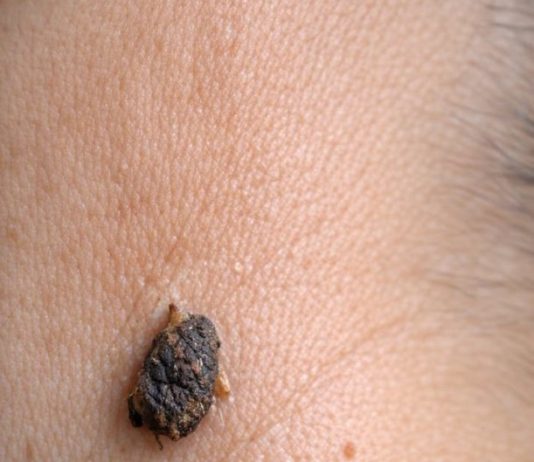Rub this 1 trick on your neck and get rid of skin tags, dark spots, and raised bumps