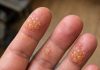 Husband’s fingers are covered in these tiny water blisters. He can’t even type for work. We need help asap!