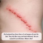 My husband has these lines of red bumps all over his side. They itch like crazy and look inflamed. We are scared it’s an infection. What is this?