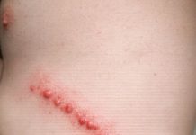 My husband has these lines of red bumps all over his side. They itch like crazy and look inflamed. We are scared it’s an infection. What is this?