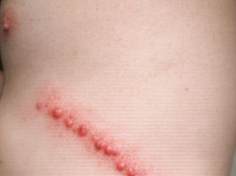 My husband has these lines of red bumps all over his side. They itch like crazy and look inflamed. We are scared it’s an infection. What is this?