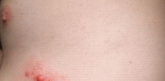 My husband has these lines of red bumps all over his side. They itch like crazy and look inflamed. We are scared it’s an infection. What is this?