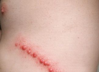 My husband has these lines of red bumps all over his side. They itch like crazy and look inflamed. We are scared it’s an infection. What is this?