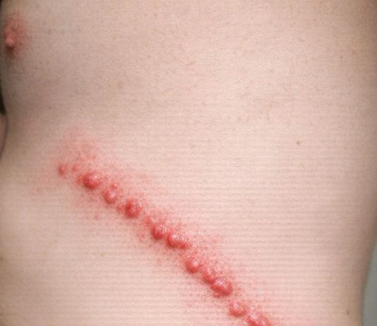 My husband has these lines of red bumps all over his side. They itch like crazy and look inflamed. We are scared it’s an infection. What is this?