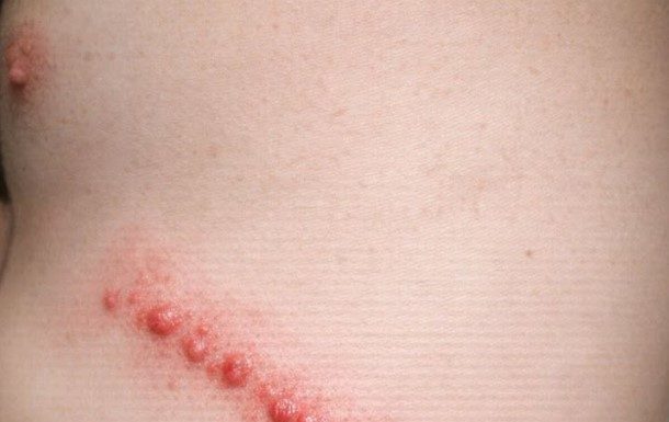 My husband has these lines of red bumps all over his side. They itch like crazy and look inflamed. We are scared it’s an infection. What is this?