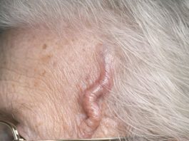 My grandmother has a pounding headache and this vessel on her temple is bulging and tender. She says her jaw hurts when she eats. The ER wait is awful right now. Is this an emergency?