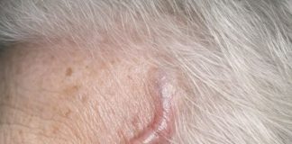 My grandmother has a pounding headache and this vessel on her temple is bulging and tender. She says her jaw hurts when she eats. The ER wait is awful right now. Is this an emergency?