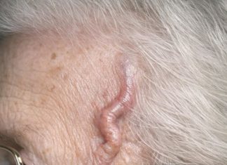 My grandmother has a pounding headache and this vessel on her temple is bulging and tender. She says her jaw hurts when she eats. The ER wait is awful right now. Is this an emergency?