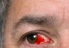 My husband just looked in the mirror and screamed. His eye is full of blood. No pain but it looks severe. Can’t get into the ophthalmologist today. Is this an emergency?