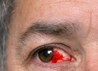 My husband just looked in the mirror and screamed. His eye is full of blood. No pain but it looks severe. Can’t get into the ophthalmologist today. Is this an emergency?