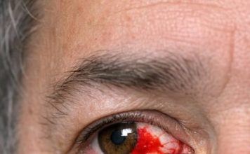 My husband just looked in the mirror and screamed. His eye is full of blood. No pain but it looks severe. Can’t get into the ophthalmologist today. Is this an emergency?