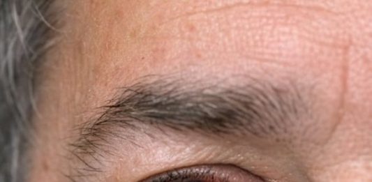 My husband just looked in the mirror and screamed. His eye is full of blood. No pain but it looks severe. Can’t get into the ophthalmologist today. Is this an emergency?