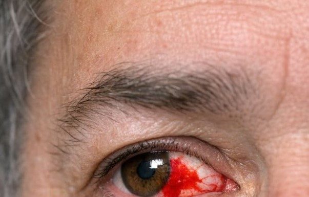 My husband just looked in the mirror and screamed. His eye is full of blood. No pain but it looks severe. Can’t get into the ophthalmologist today. Is this an emergency?