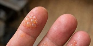 Husband’s fingers are covered in these tiny water blisters. He can’t even type for work. We need help asap!