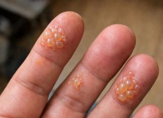 Husband’s fingers are covered in these tiny water blisters. He can’t even type for work. We need help asap!