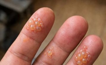 Husband’s fingers are covered in these tiny water blisters. He can’t even type for work. We need help asap!