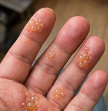 Husband’s fingers are covered in these tiny water blisters. He can’t even type for work. We need help asap!