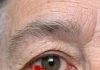 My 64-year-old husband woke up with this blood red patch on his eye. Do we need to go to the hospital?