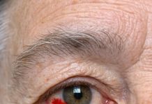 My 64-year-old husband woke up with this blood red patch on his eye. Do we need to go to the hospital?