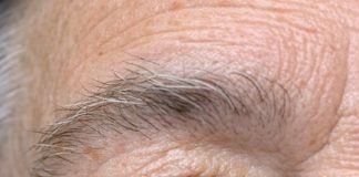 My 64-year-old husband woke up with this blood red patch on his eye. Do we need to go to the hospital?