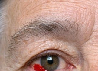 My 64-year-old husband woke up with this blood red patch on his eye. Do we need to go to the hospital?