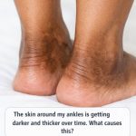The skin around my ankles is getting darker and thicker over time. What causes this?