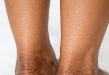 The skin around my ankles is getting darker and thicker over time. What causes this?