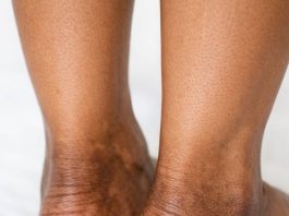 The skin around my ankles is getting darker and thicker over time. What causes this?
